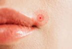 Bouton de fièvre : quelle huile essentielle utiliser pour apaiser rapidement ?