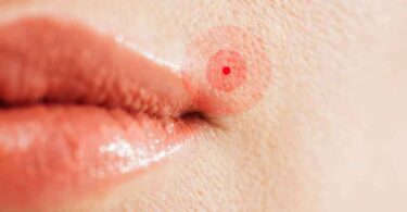 Bouton de fièvre : quelle huile essentielle utiliser pour apaiser rapidement ?