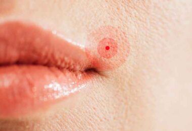 Bouton de fièvre : quelle huile essentielle utiliser pour apaiser rapidement ?